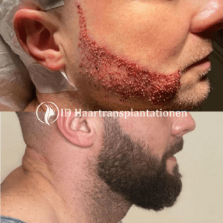 Barttransplantation Mannheim