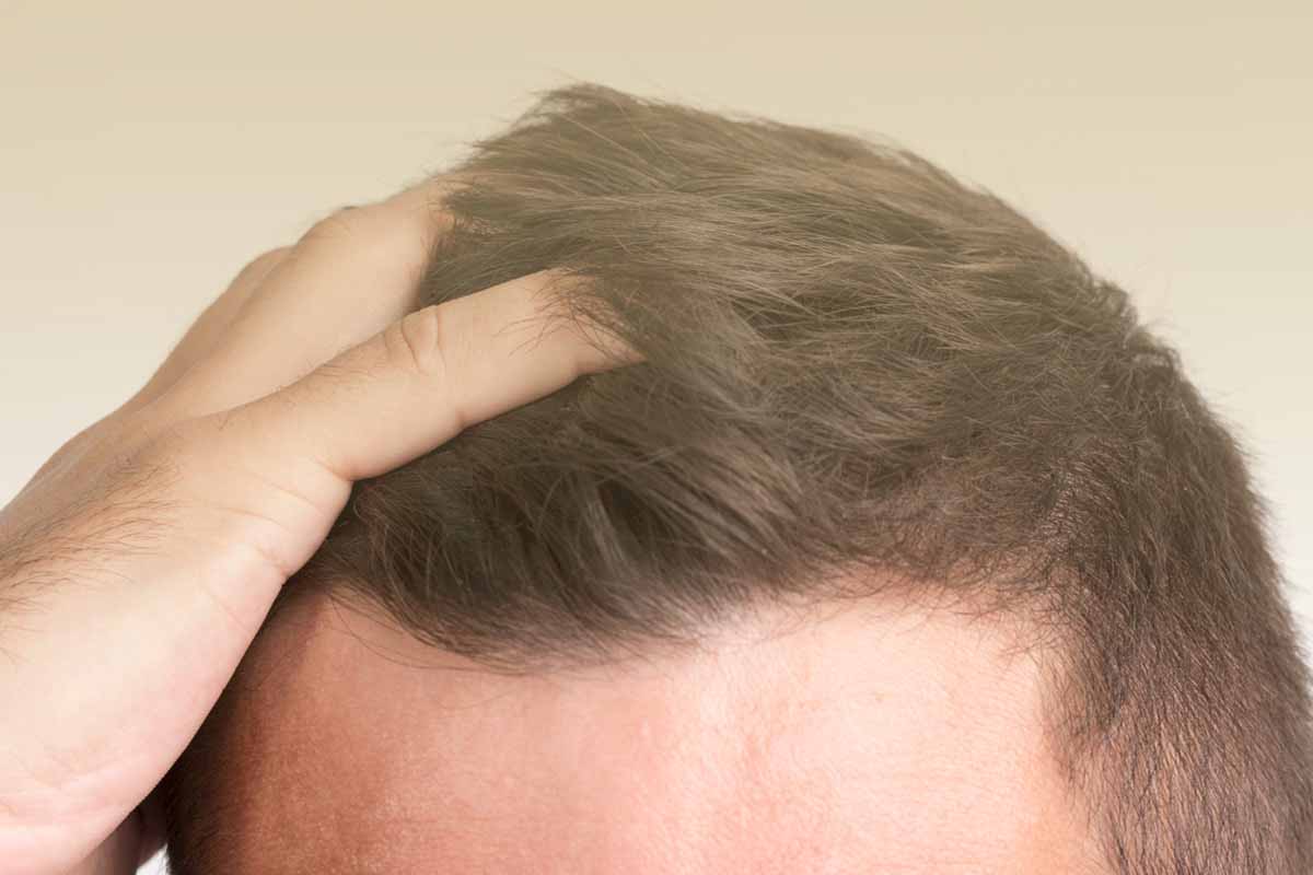Hairtransplant in Mannheim
